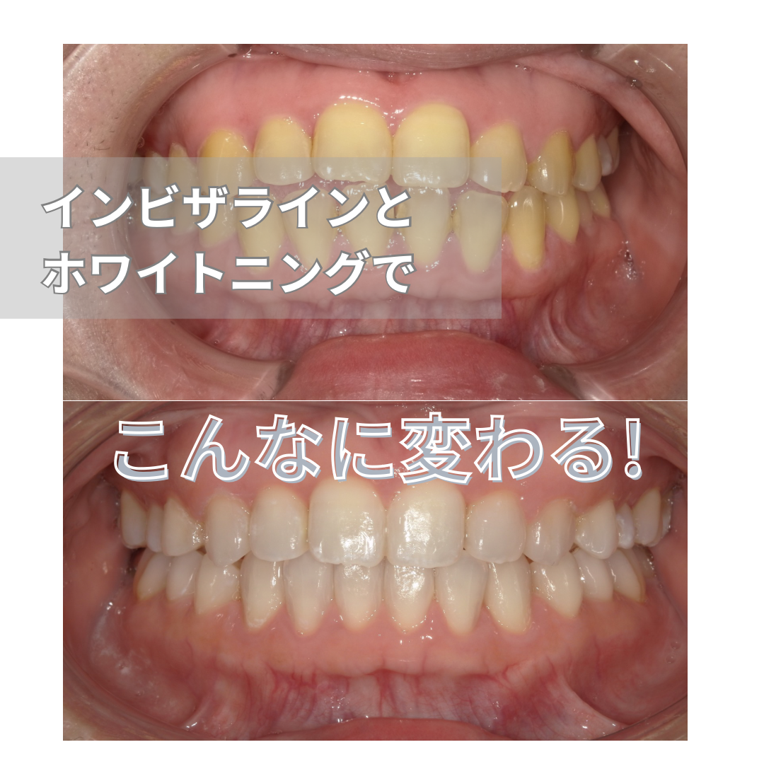 インビザラインとホワイトニングで長年のお悩みが解消！