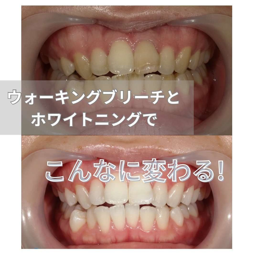 ウォーキングブリーチとホワイトニングで驚きのビフォーアフター！