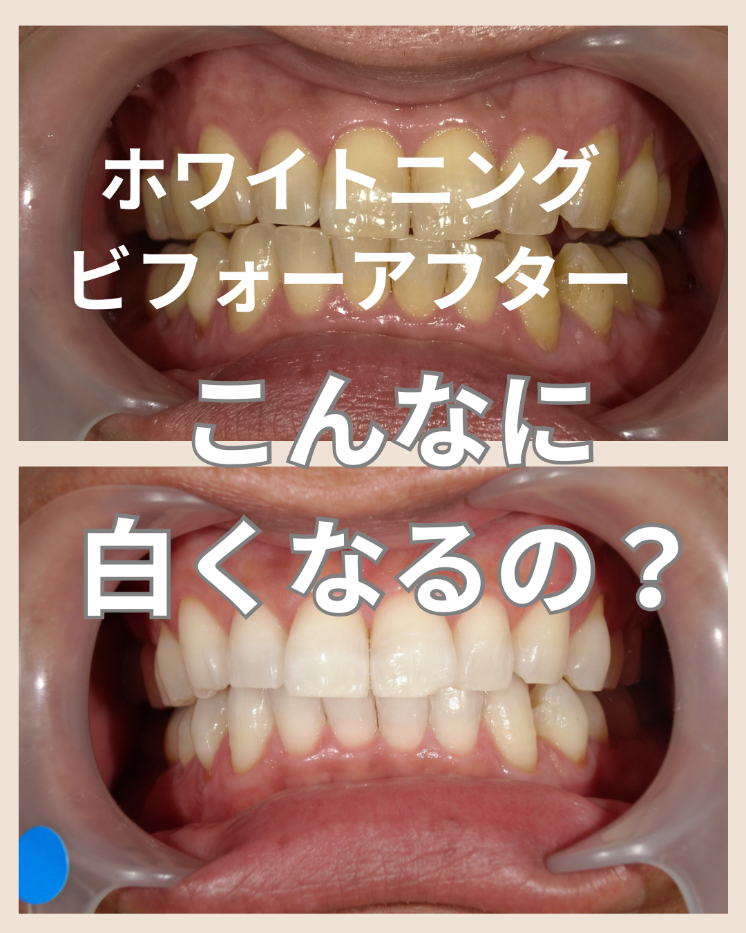 こんなに白くなるの？！ビフォーアフター【ホワイトニング】