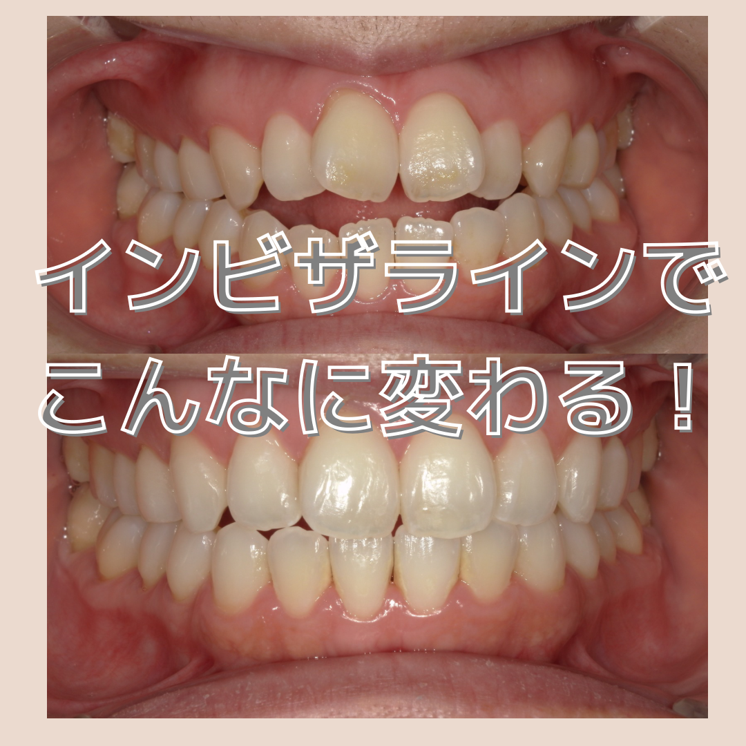 ビフォーアフター【インビザライン】