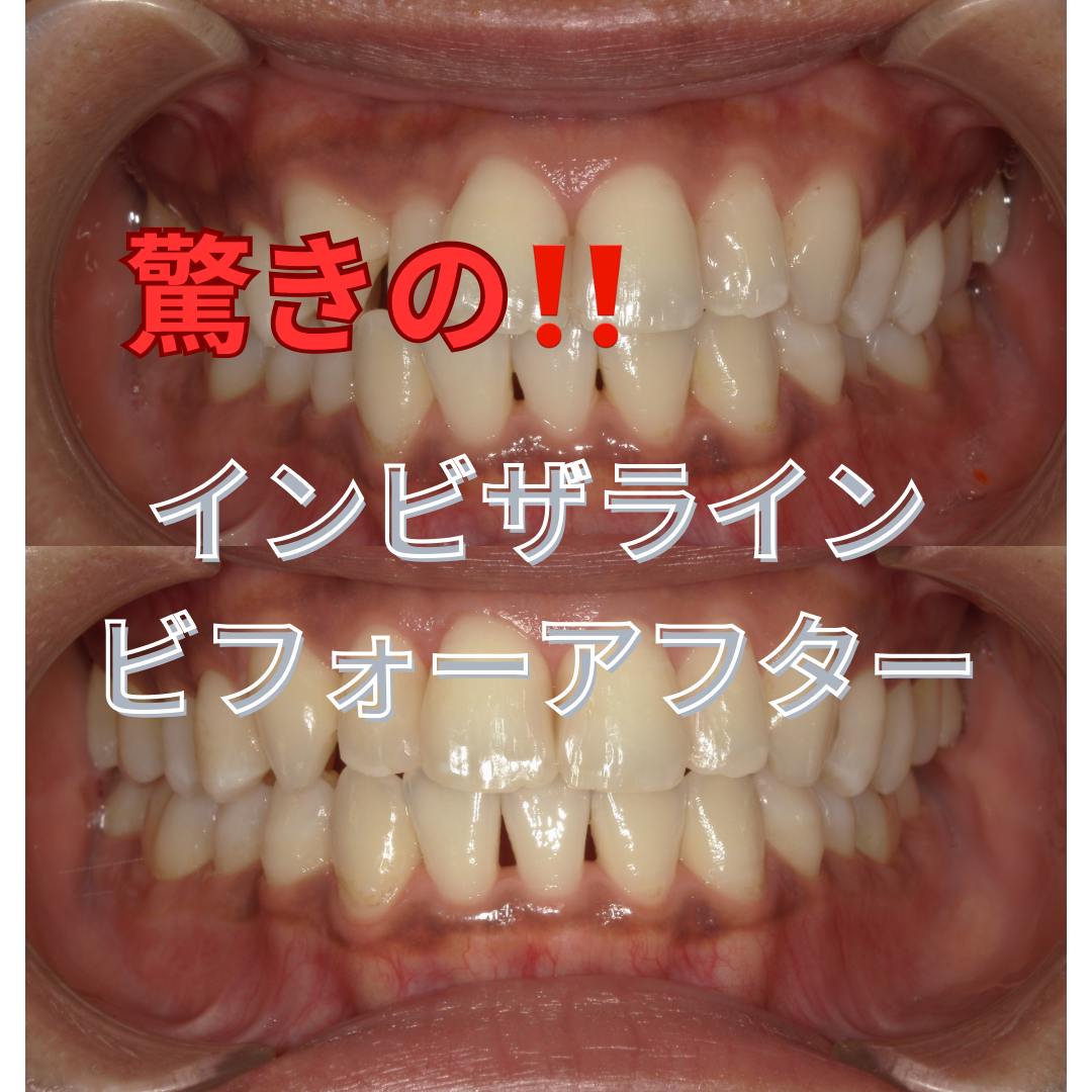 ビフォーアフター【インビザライン】